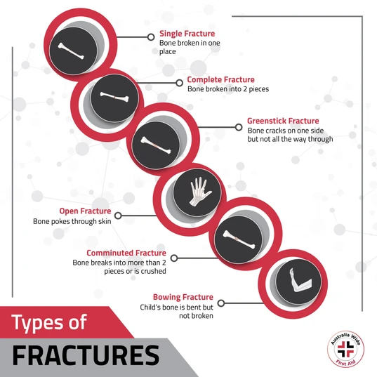 Types of bone fractures